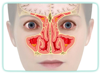 entzündete Nasennebenhöhlen